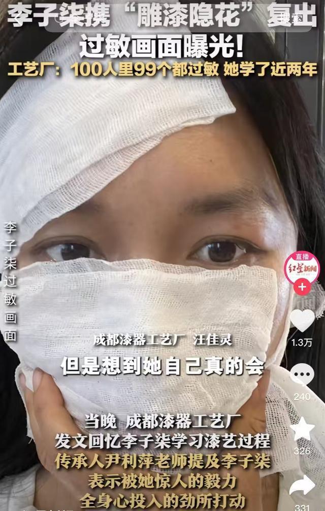 李子柒生漆过敏，全身红肿多次住院，老师揭秘更多感人故事插图